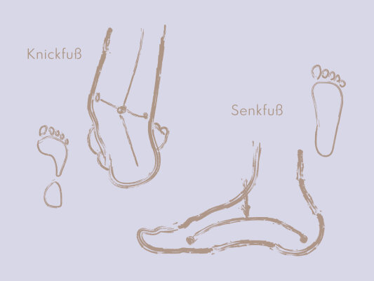 Was tun bei Knick- und Senkfuß? - Knick-und Senkfuß mit feeelt-Einlagen ausgleichen
