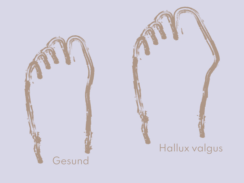 Großer Zeh auf Abwegen beim Hallux valgus